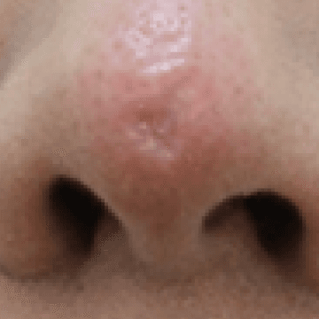 코 모공 함몰 흉터